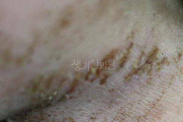 아토피 치료 전